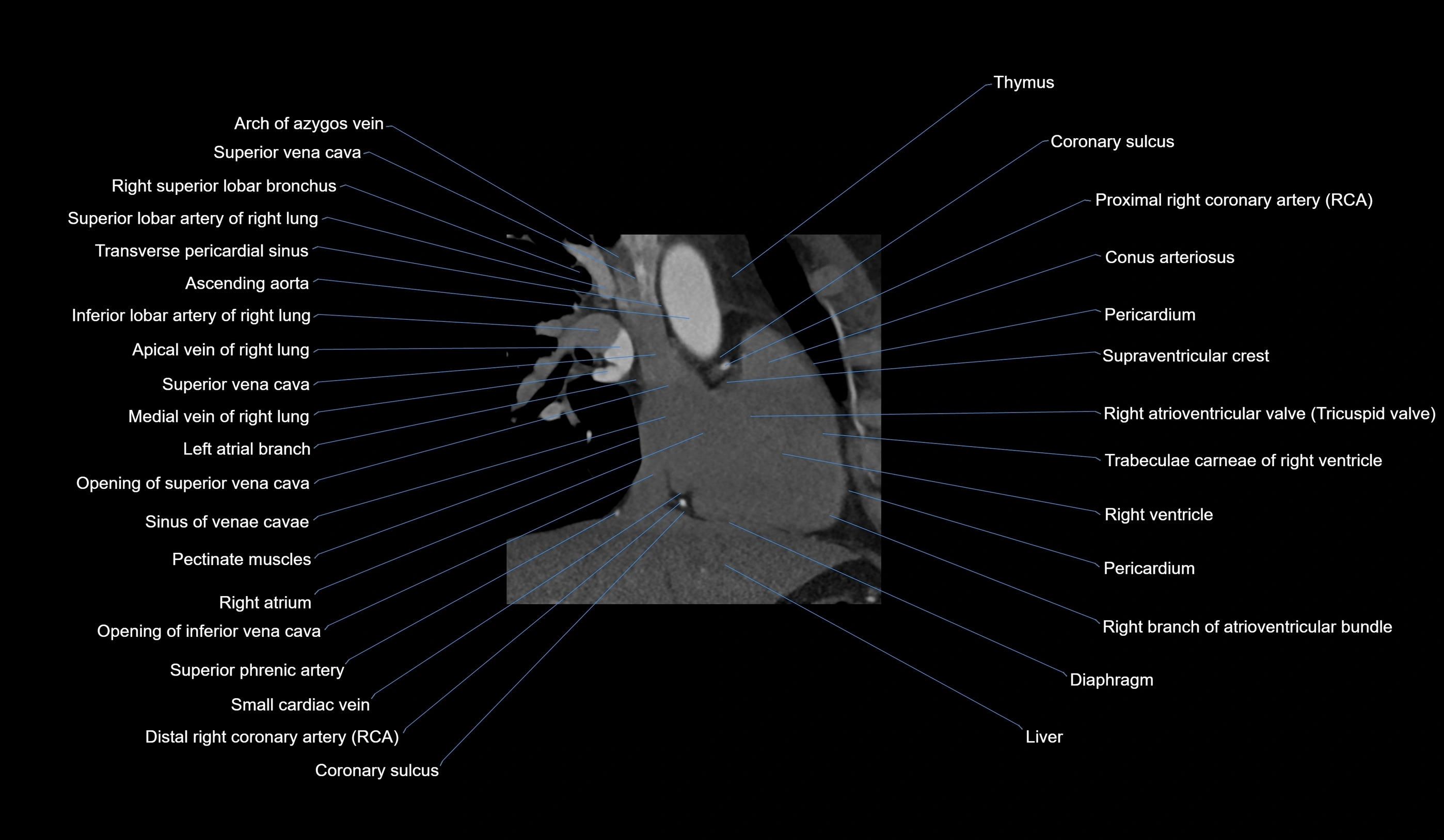 CT heart (coronary angiogram) 2 chamber view cross sectional anatomy labelled radiology image-00029.webp